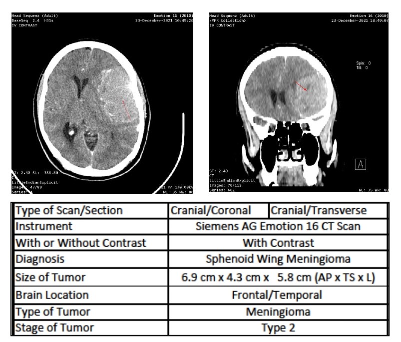 <p>Contrast-Enhanced CT Imaging of Meningioma