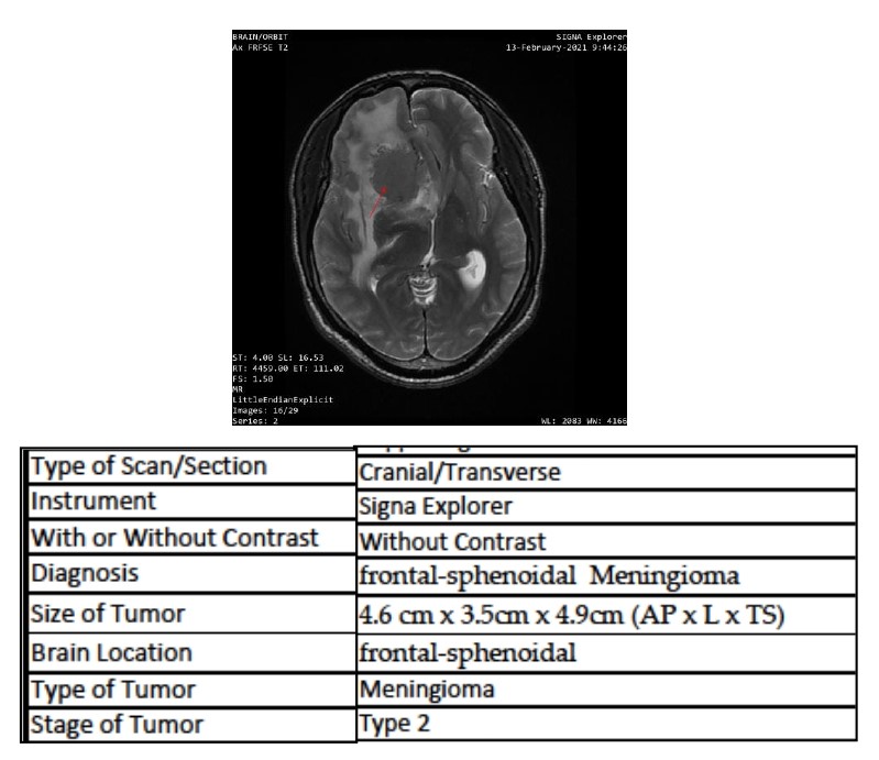 <p>MRI of a Frontosphenoidal Meningioma in Foster Kennedy Syndrome