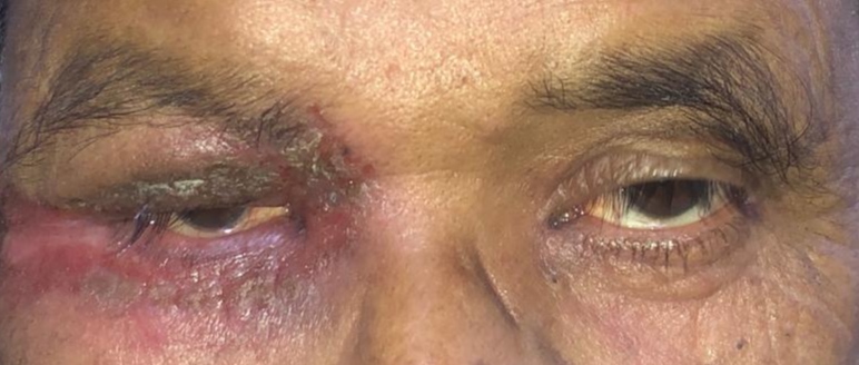 <p>Anterior Blepharitis