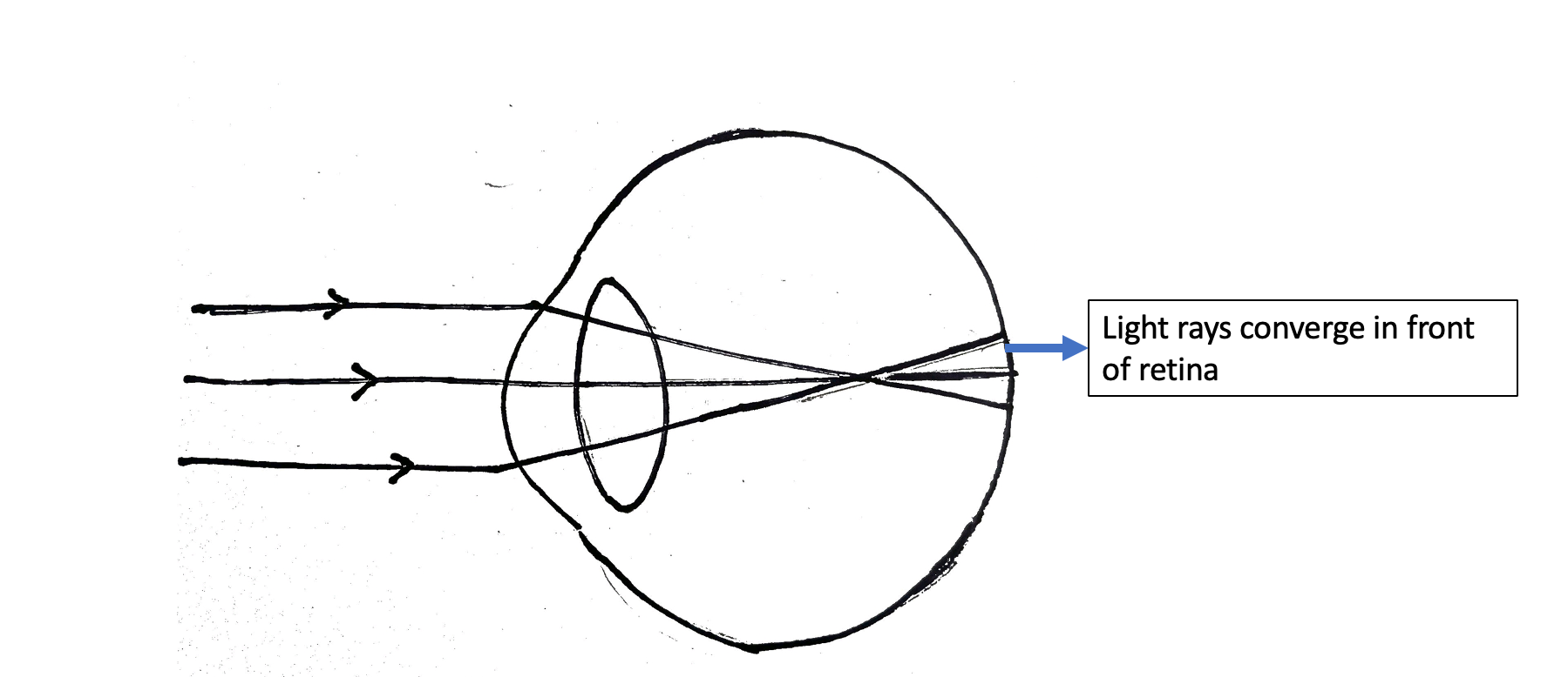 <p>Myopia. A ray diagram demonstrating parallel rays focused in front of the retina, resulting in myopia.</p>