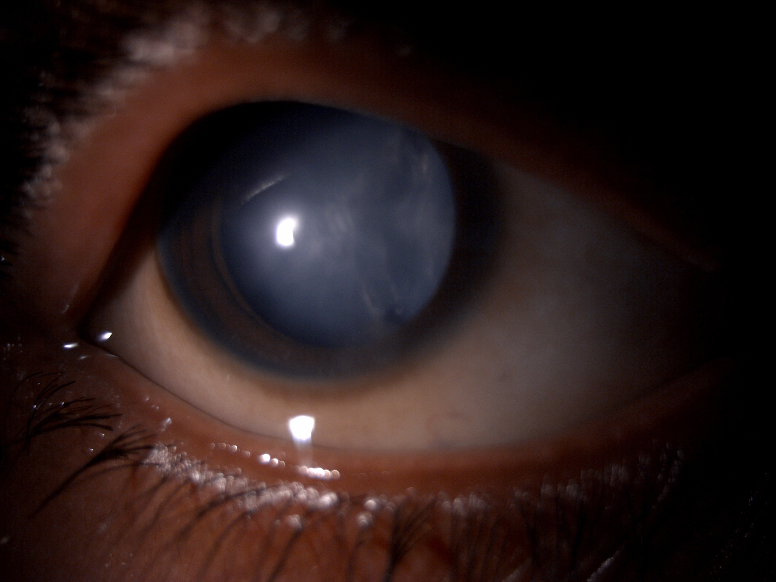 <p>Charles Bonnet Syndrome. This image shows a cataractous lens in a patient with Charles Bonnet syndrome.</p>