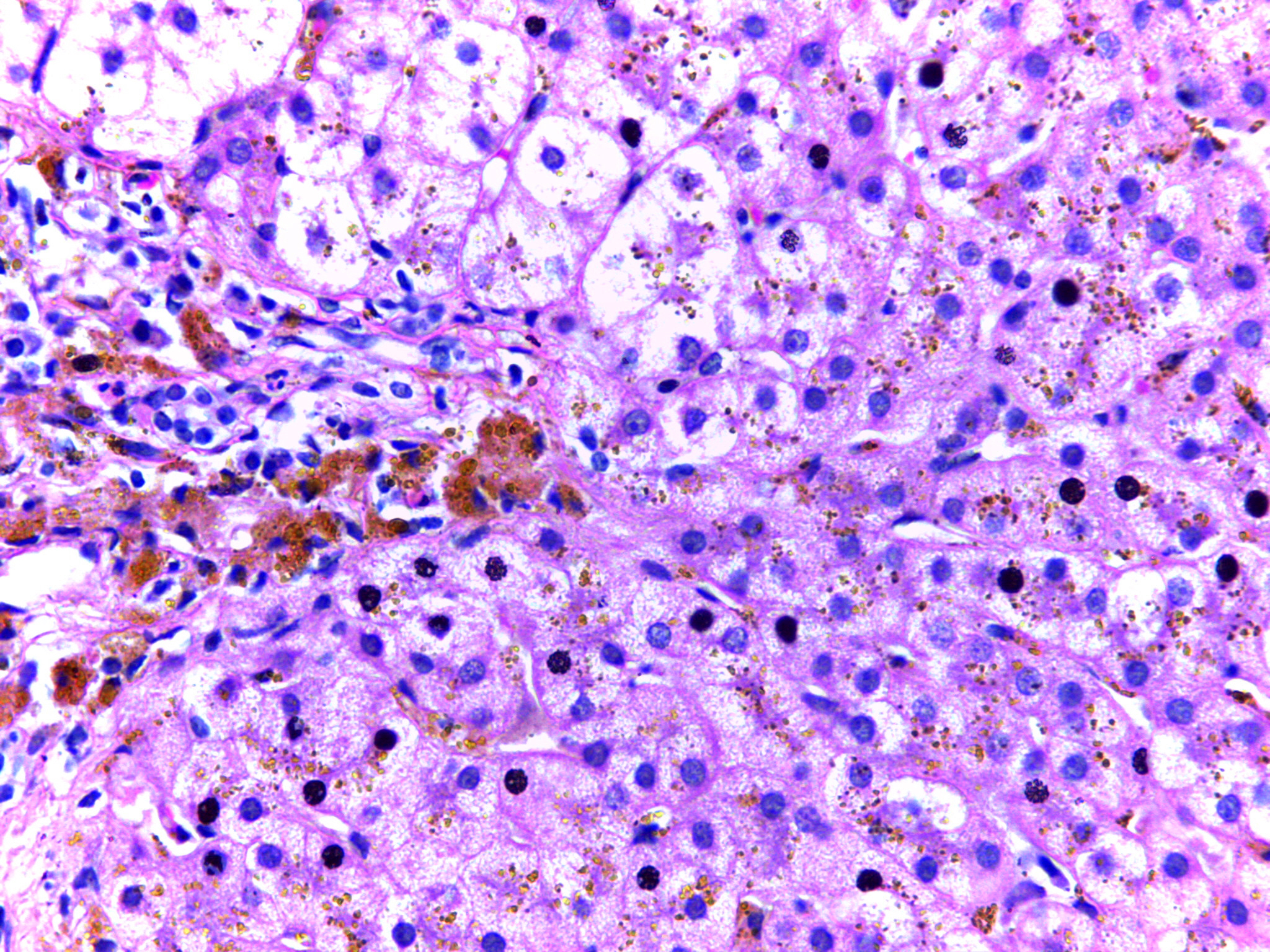 <p>Micrograph of Hepatic Iron Deposition in Hereditary Hemochromatosis