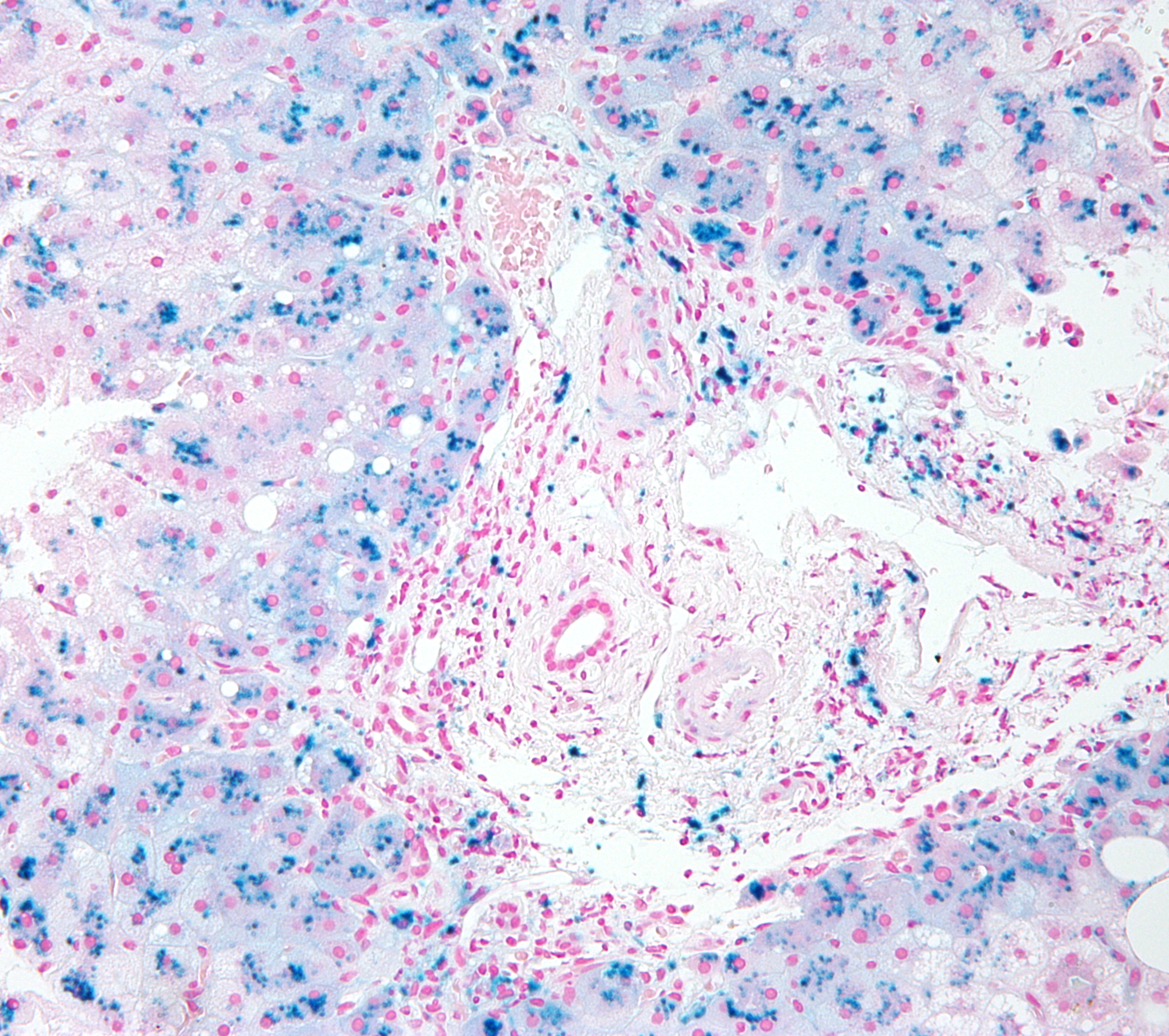 <p>High-Magnification Micrograph of Hepatic Iron Deposition in Hereditary Hemochromatosis
