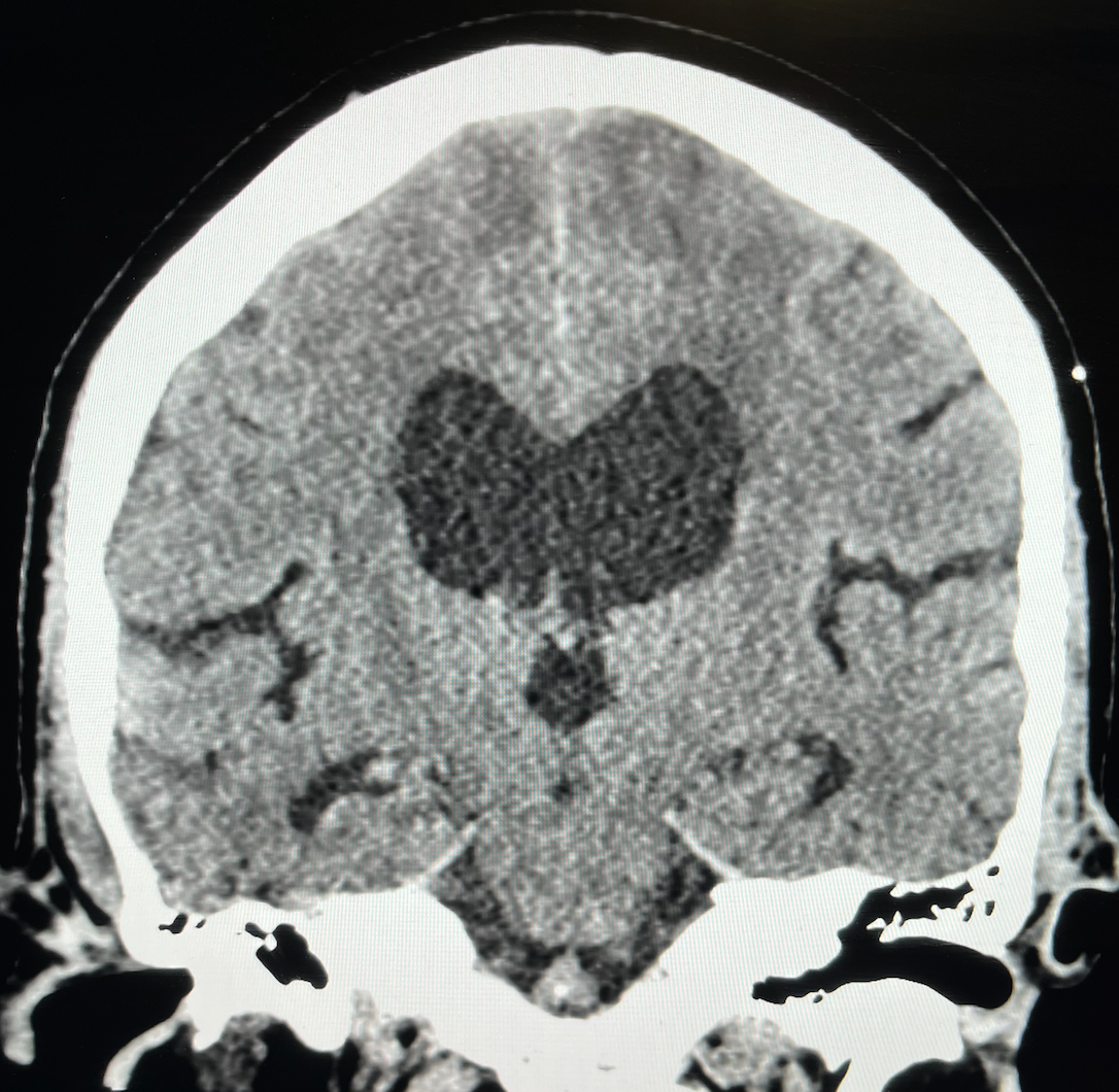 <p>Normal Pressure Hydrocephalus Imaging