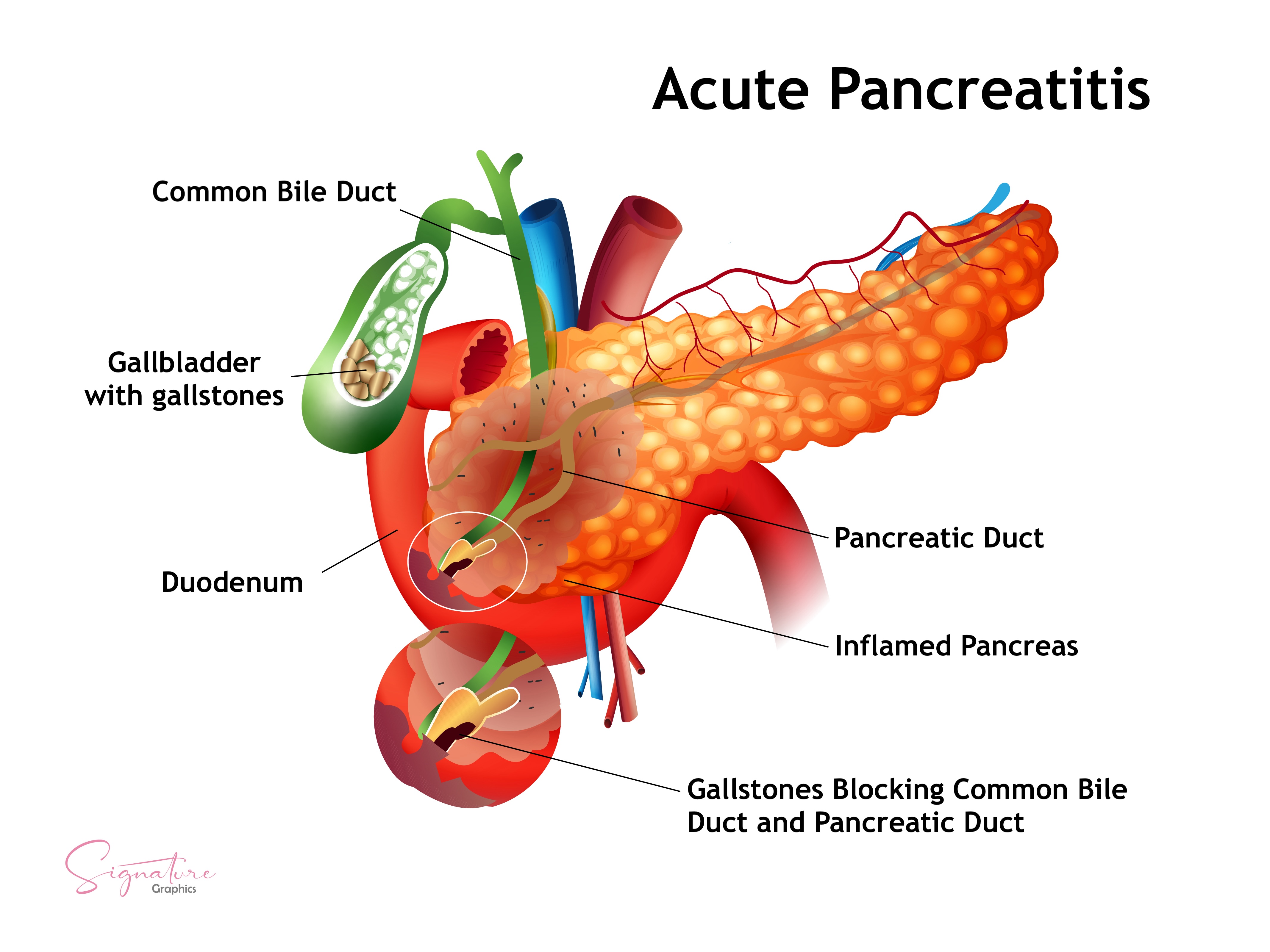 <p>Gallstone-Induced Acute Pancreatitis. This image shows the mechanism by which gallstones cause pancreatic injury.</p>