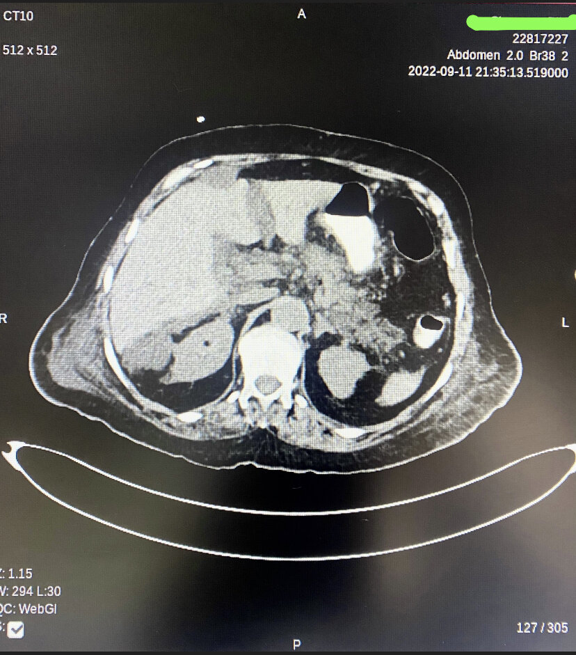 <p>Necrotizing Pancreatitis with Extensive Peripancreatic Nodularity