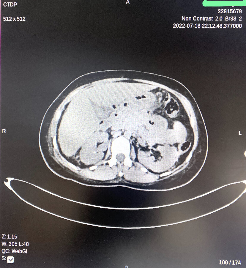 <p>Peripancreatic Necrotic Fluid on Computed Tomography