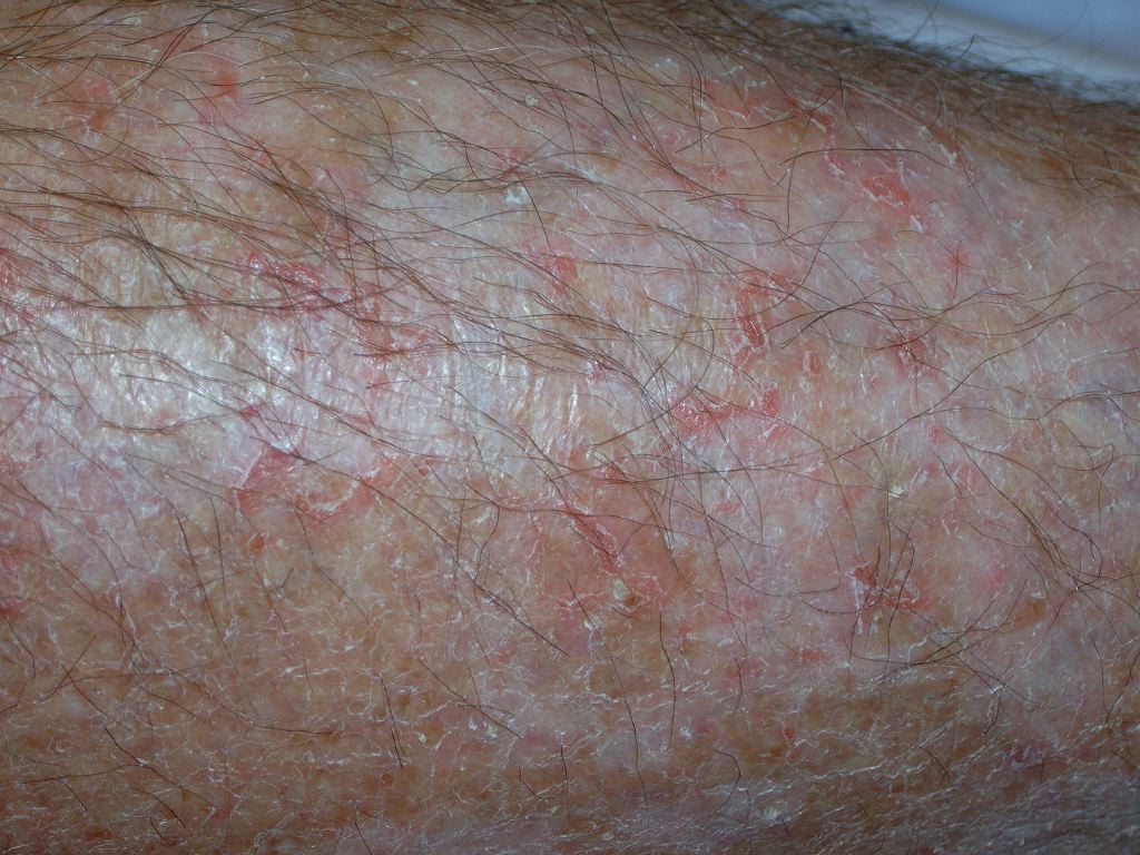 <p>Eczema, Craquele