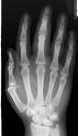 <p>PA Hand X-Ray.</p>
<p>&nbsp;</p>