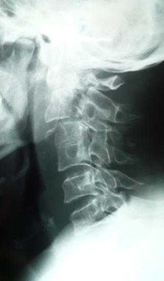 <p>Hangman's Fracture on Radiography