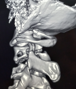 <p>Three-Dimensional Computed Tomography of a Hangman's Fracture
