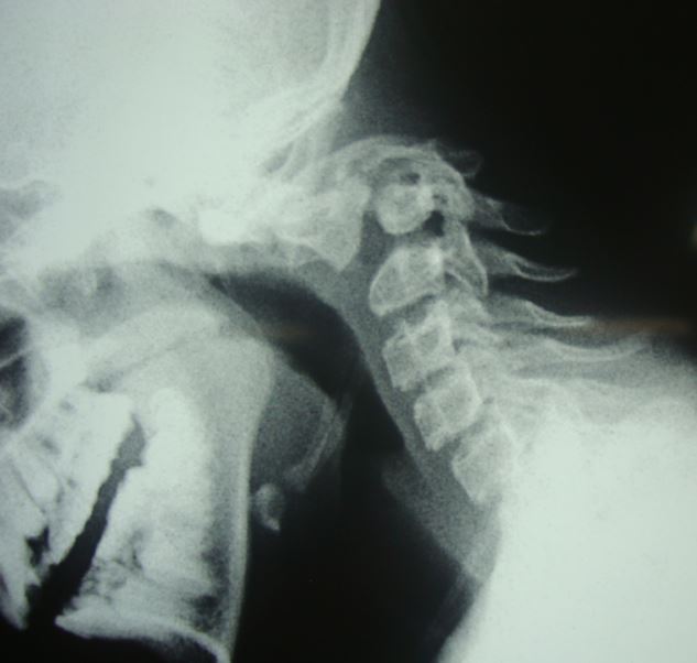 <p>Swan Neck Deformity in Neglected Traumatic Spondylolisthesis