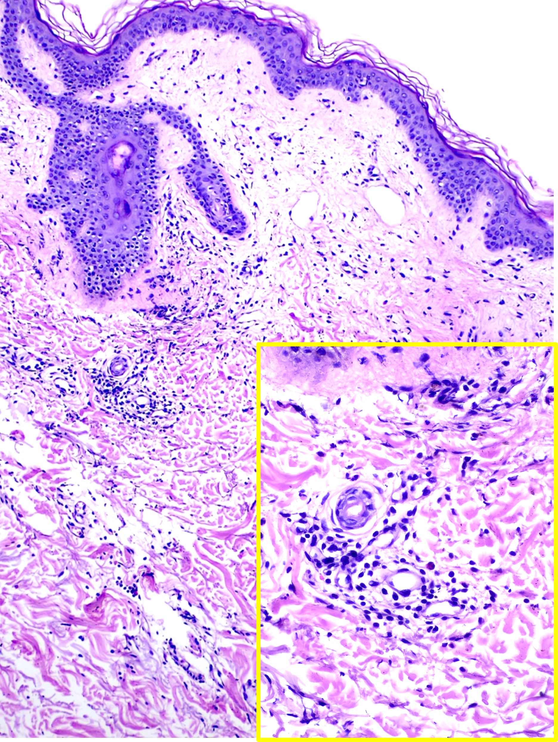 <p>Histopathology of Urticaria