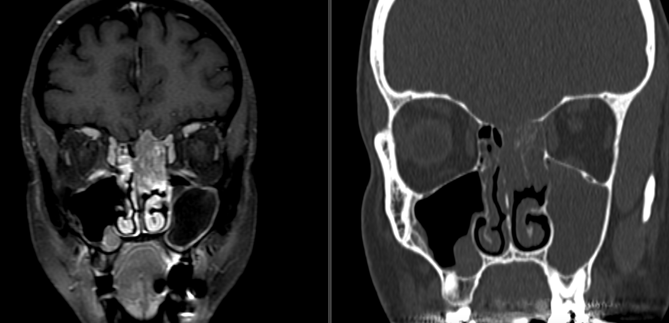 <p>Esthesioneuroblastoma. Magnetic resonance imaging of esthesioneuroblastoma.</p>