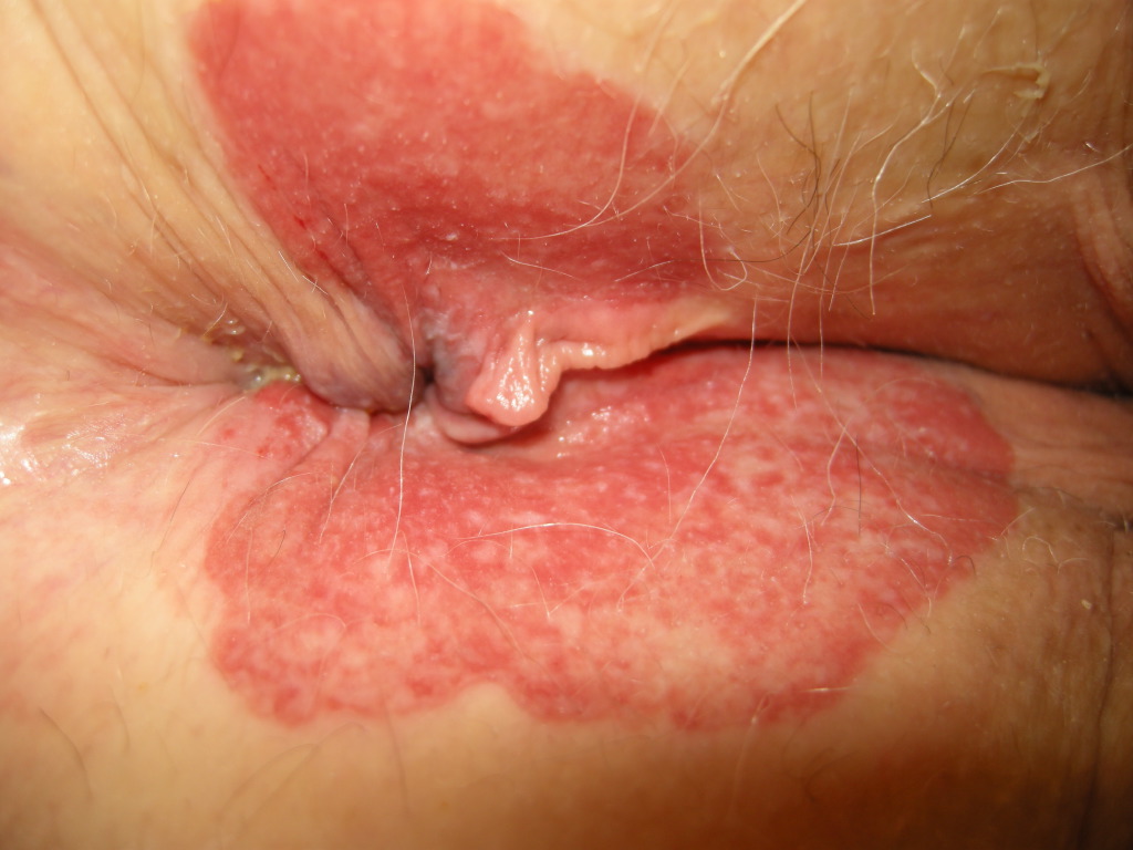 <p>Extramammary Paget Lesion