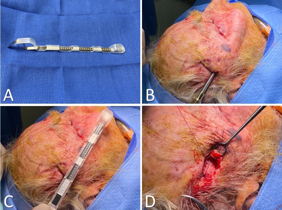 <p>Midface Lift Using a Resorbable Tine Prosthesis
