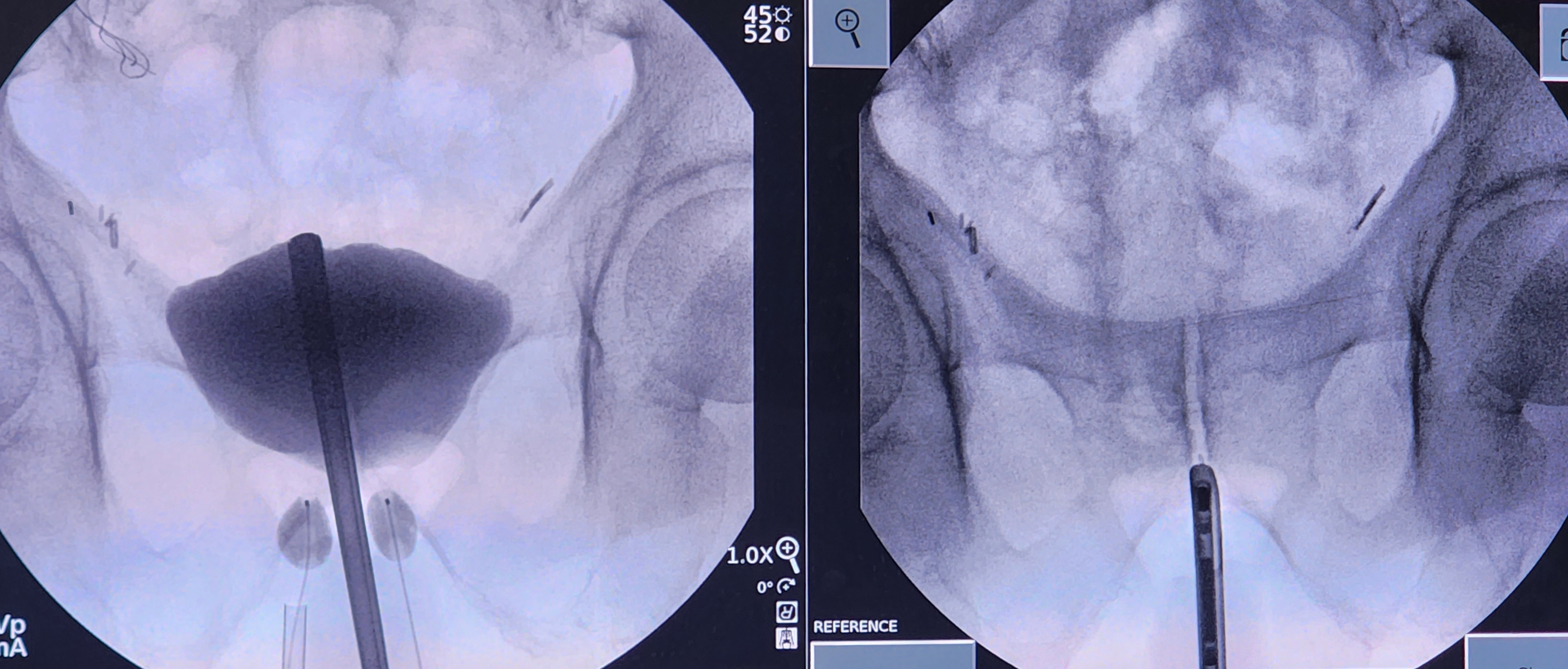 Left: Appropriate placement of dual-balloon adjustable continence therapy
Right: Anatomic reference of cystoscope at the bla