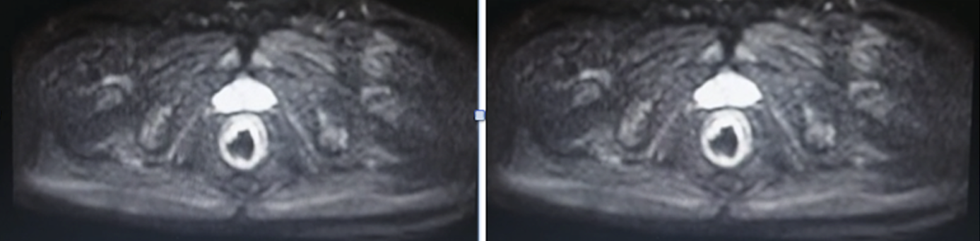 <p>Anorectal Abscess on Magnetic Resonance Imaging