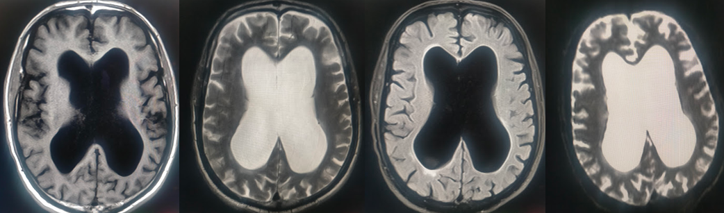 <p>Normal Pressure Hydrocephalus CT