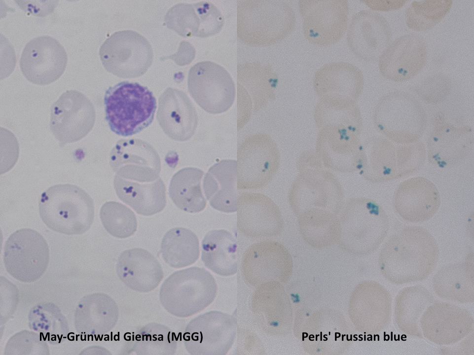 <p>Pappenheimer Bodies on Dual Stains
