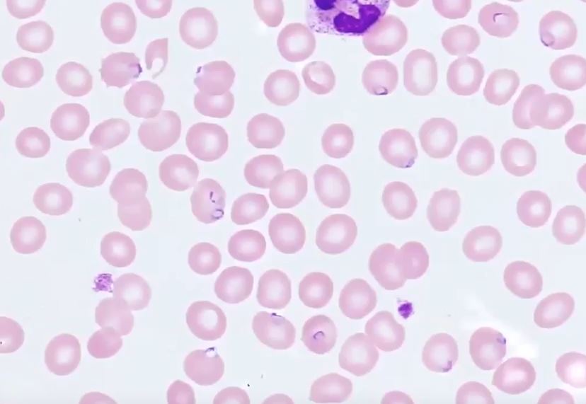 <p><em>Plasmodium falciparum</em> Ring Stage in Erythrocytes