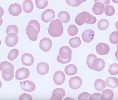<p>Babesiosis