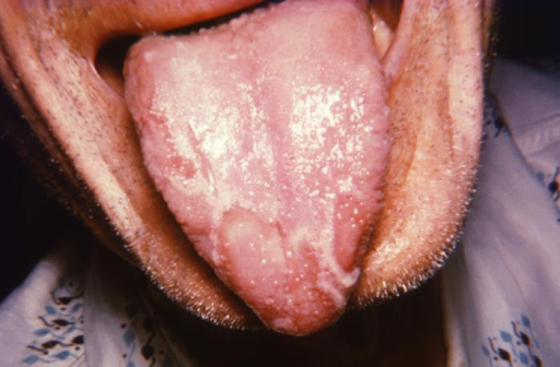 <p>Benign migratory glossitis (geographic tongue)