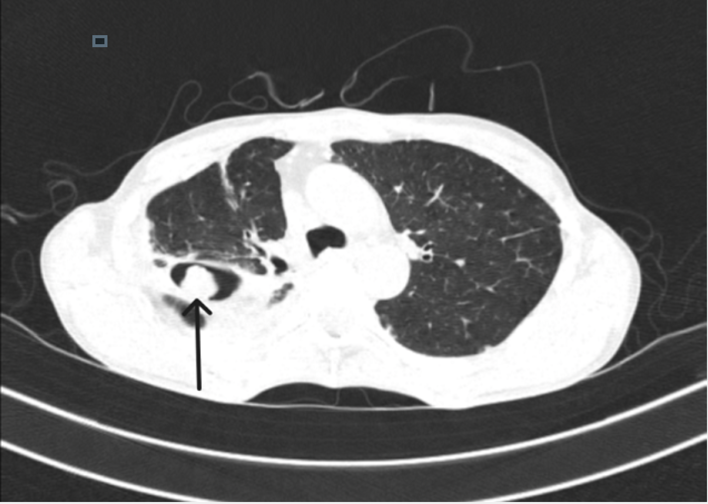 <p>Aspergilloma Mass