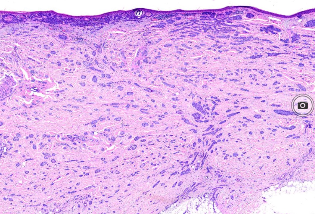 <p>Micronodular Basal Cell Carcinoma