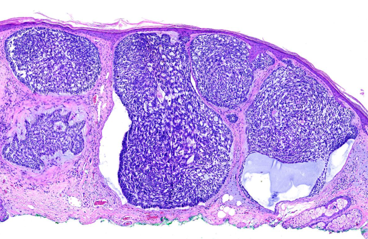 <p>Basal Cell Carcinoma, Nodular