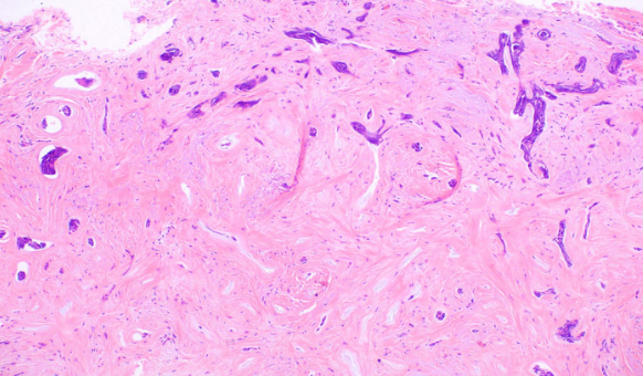 <p>Basal Cell Carcinoma, Morpheaform