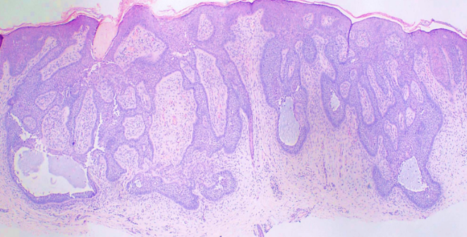 <p>Basal Cell Carcinoma, Fibroepithelioma of Pinkus