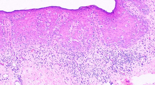 <p>Extramammary Paget Disease. Histological image of EMPD in which the proliferative neoplastic cell is the Paget cell.</p>