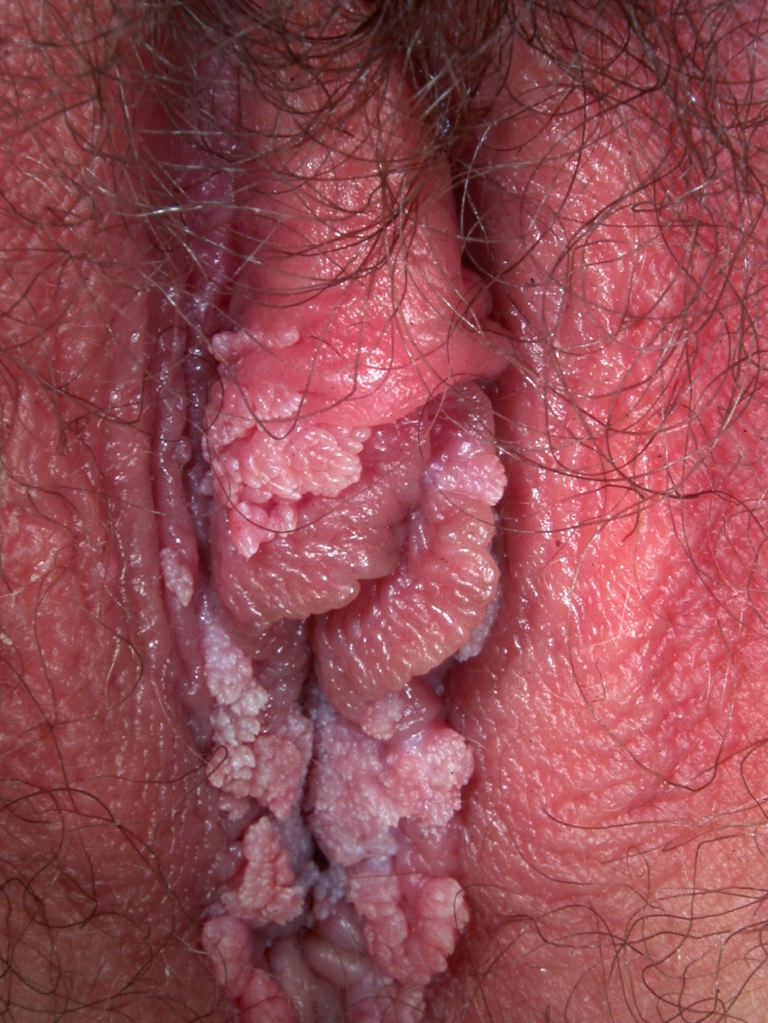 <p>Female Genital Warts