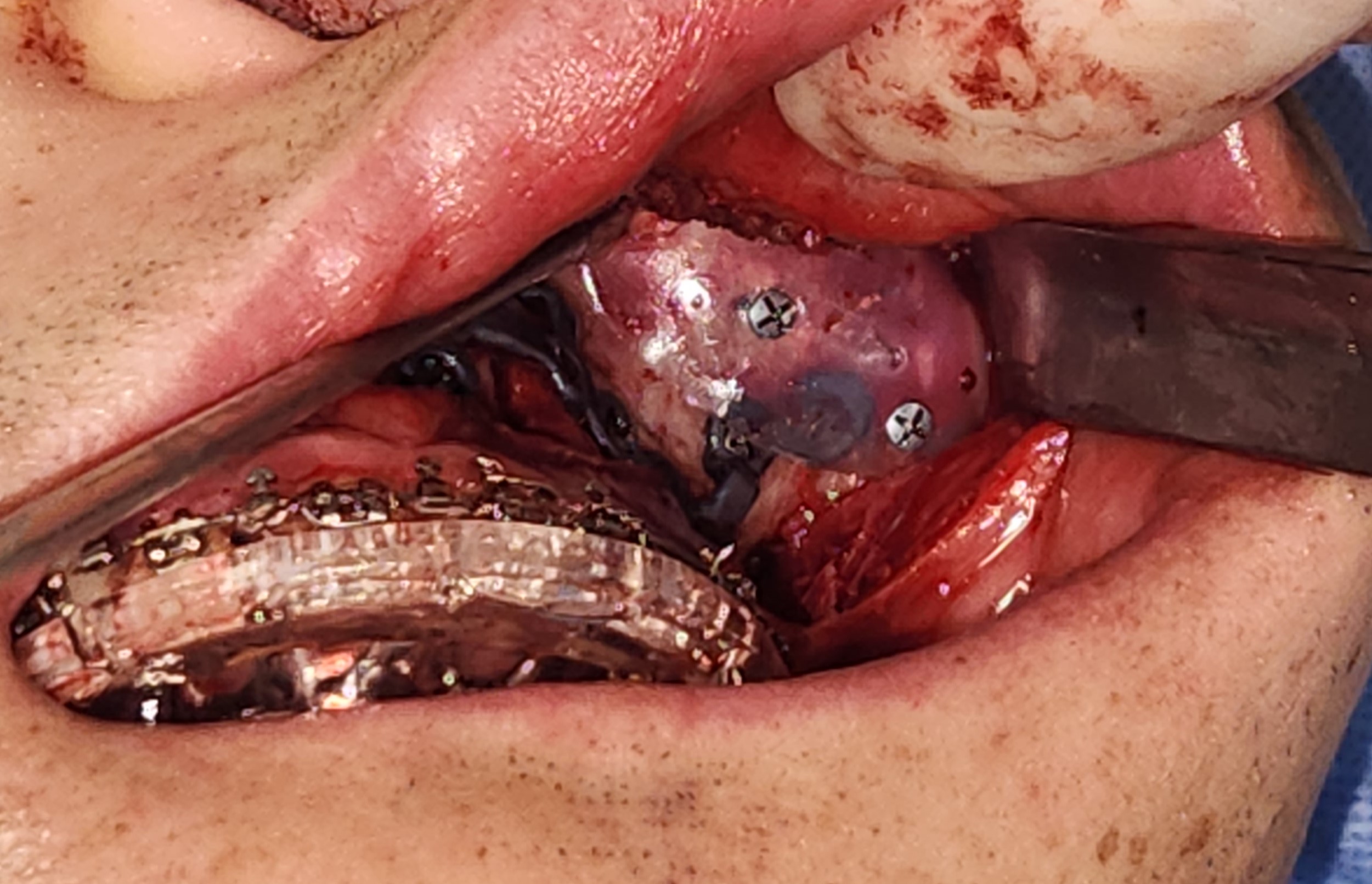 <p>Malar Implant