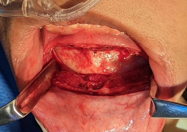 <p>Mentalis Dissection