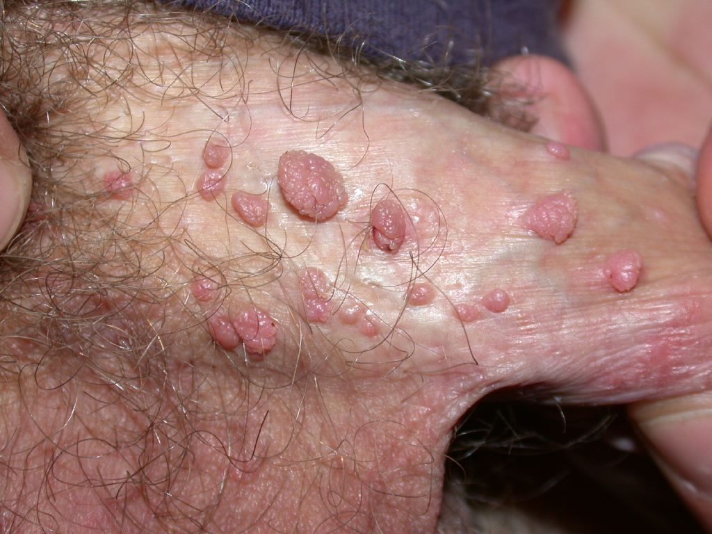 <p>Male Genital Warts