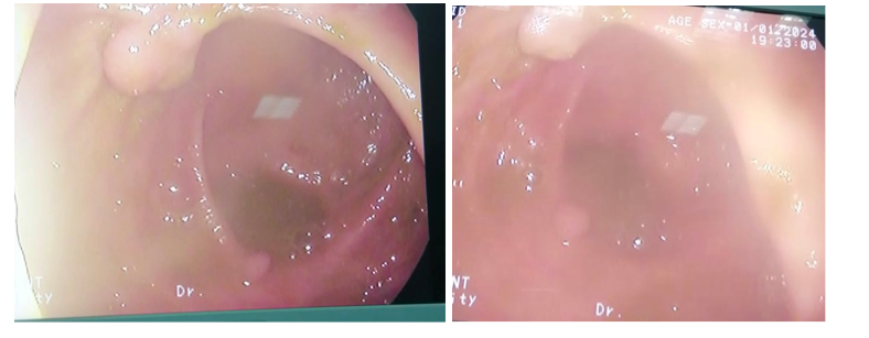 <p>Colonic Polyps on Colonoscopy. Endoscopic examination reveals multiple small mucosal polyps.</p>
<p>&nbsp;</p>