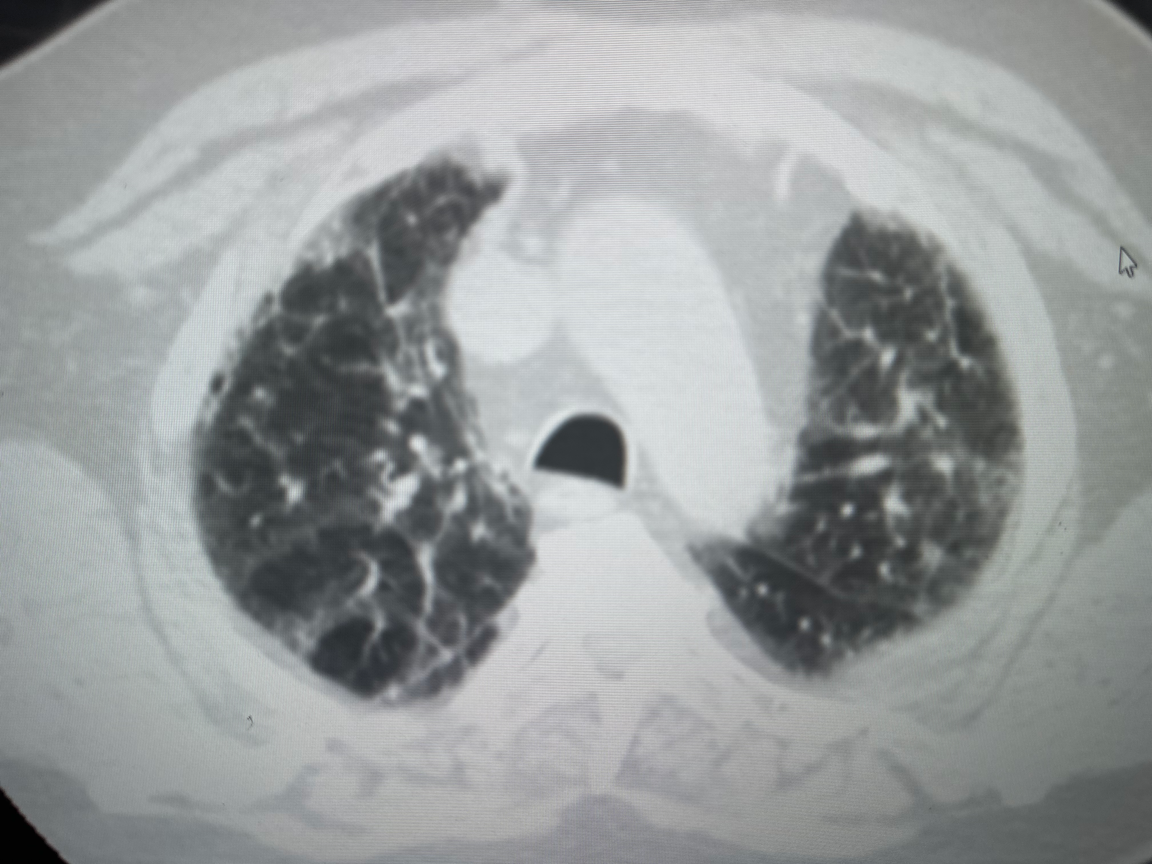 <p>Usual Interstitial Pneumonia