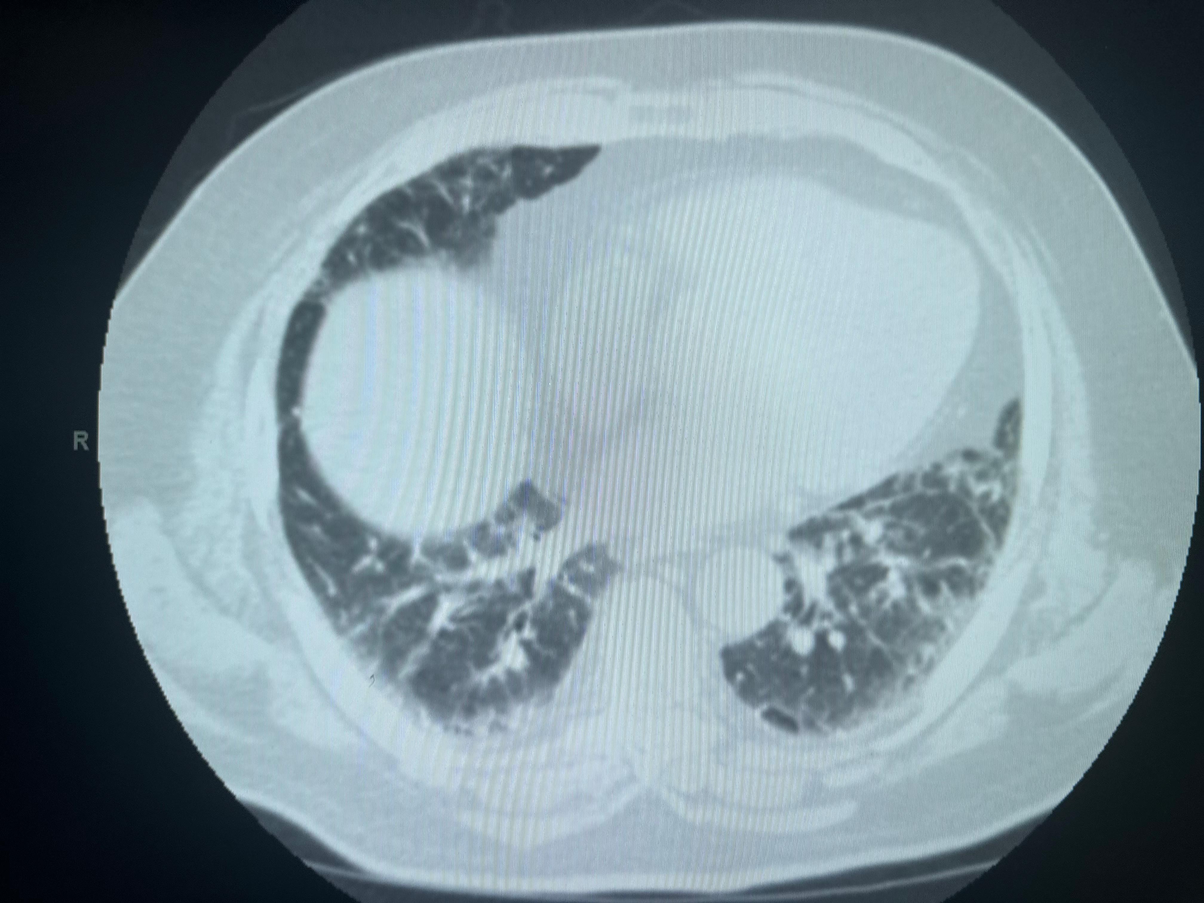 <p>Computed Tomography of the Lungs in Usual Interstitial Pneumonia