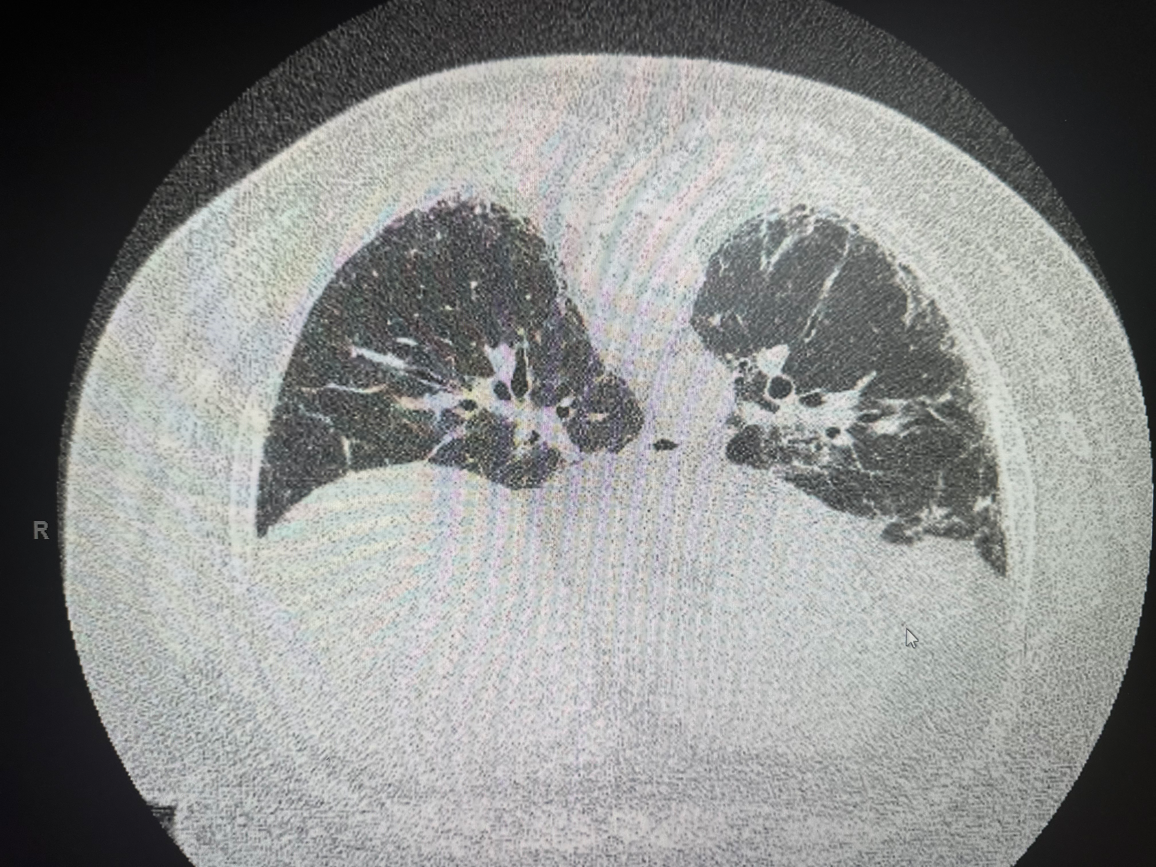 <p>Usual Interstitial Pneumonia on Axial High-Resolution Computed Tomography