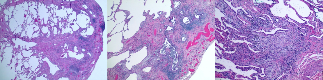 <p>Histopathology of Usual Interstitial Pneumonia in Idiopathic Pulmonary Fibrosis