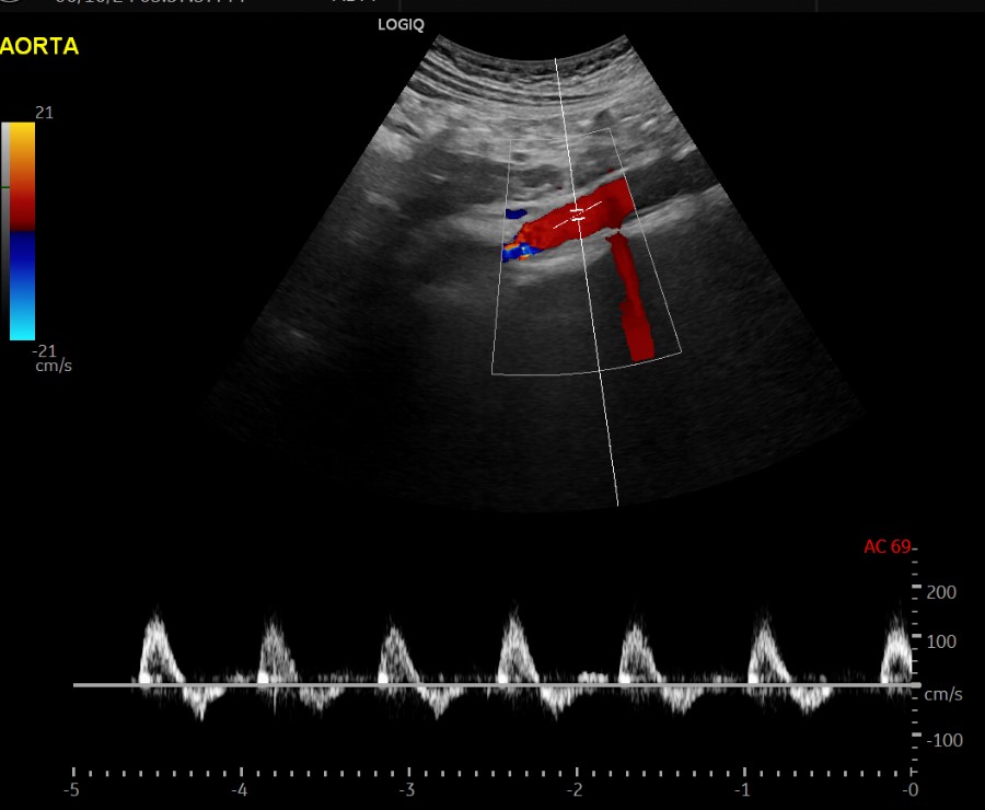 <p>Normal Abdominal Aorta Doppler