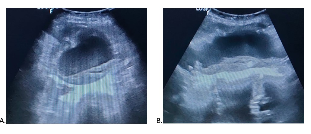 <p>Color and Spectral Ultrasound Doppler Images of Normal Abdominal Aortic Flow Pattern