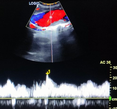 <p>Greyscale Ultrasound of an Abdominal Aortic Aneurysm
