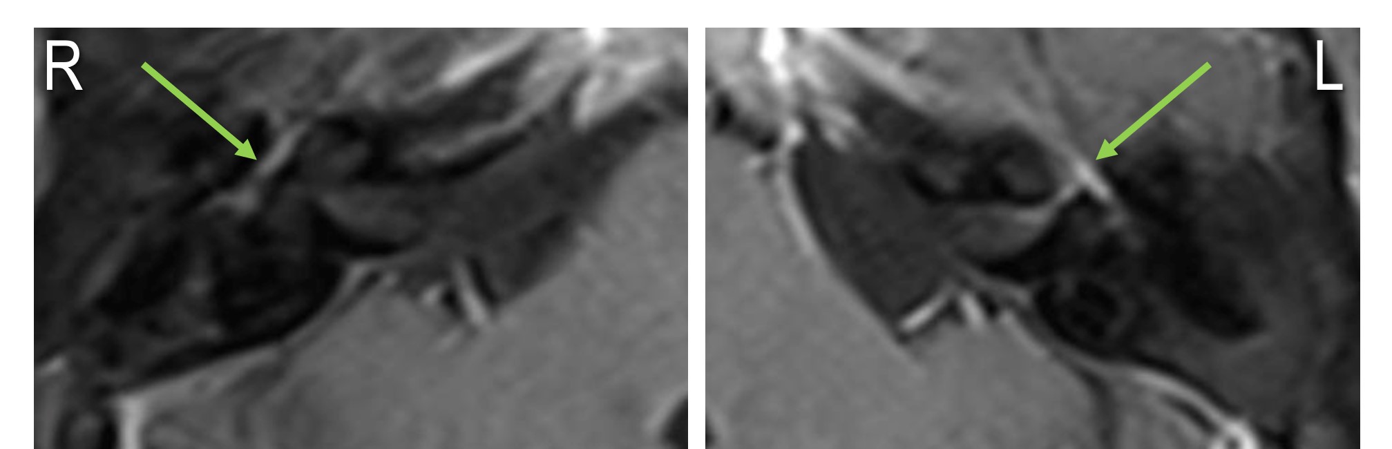 <p>Left-Sided Bell Palsy, MRI
