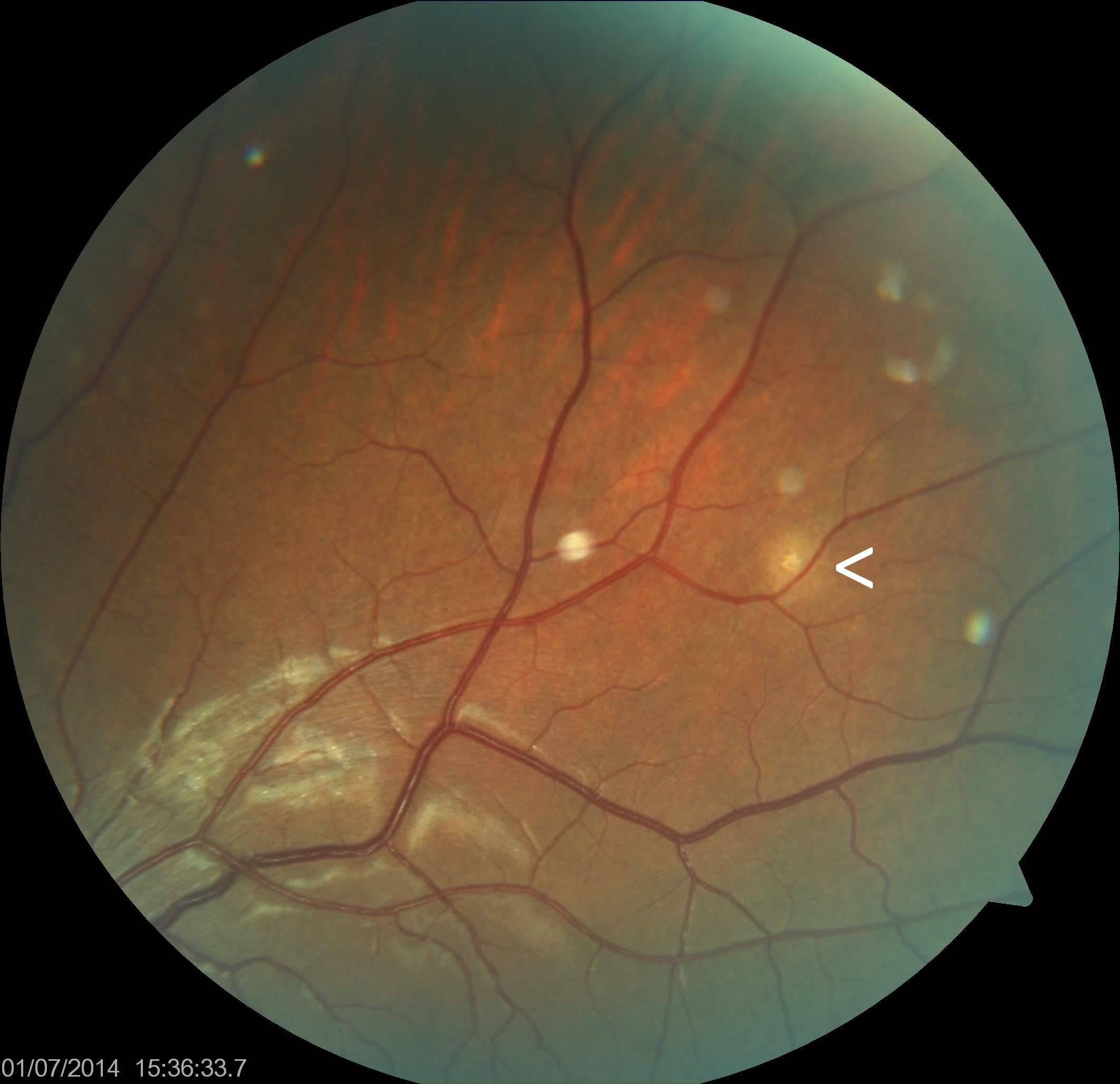 <p>Choroidal Tubercle. Choroidal tubercle (marked with <) in a patient with miliary tuberculosis.</p>