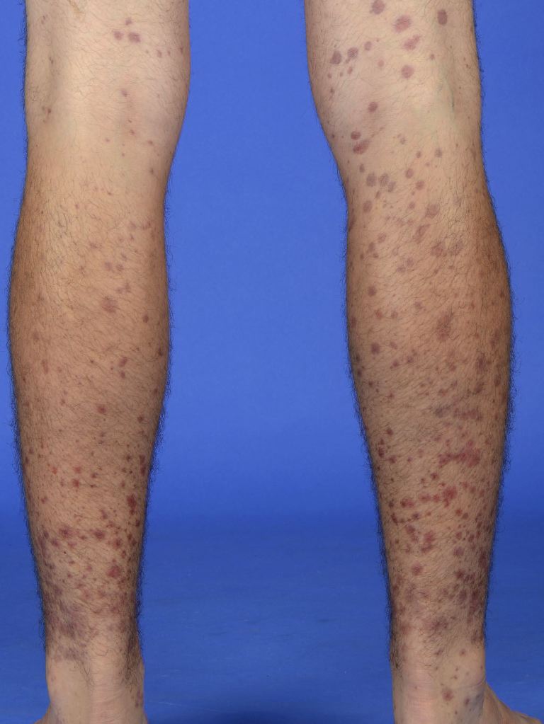 <p>Henoch-Sch&ouml;nlein Purpura