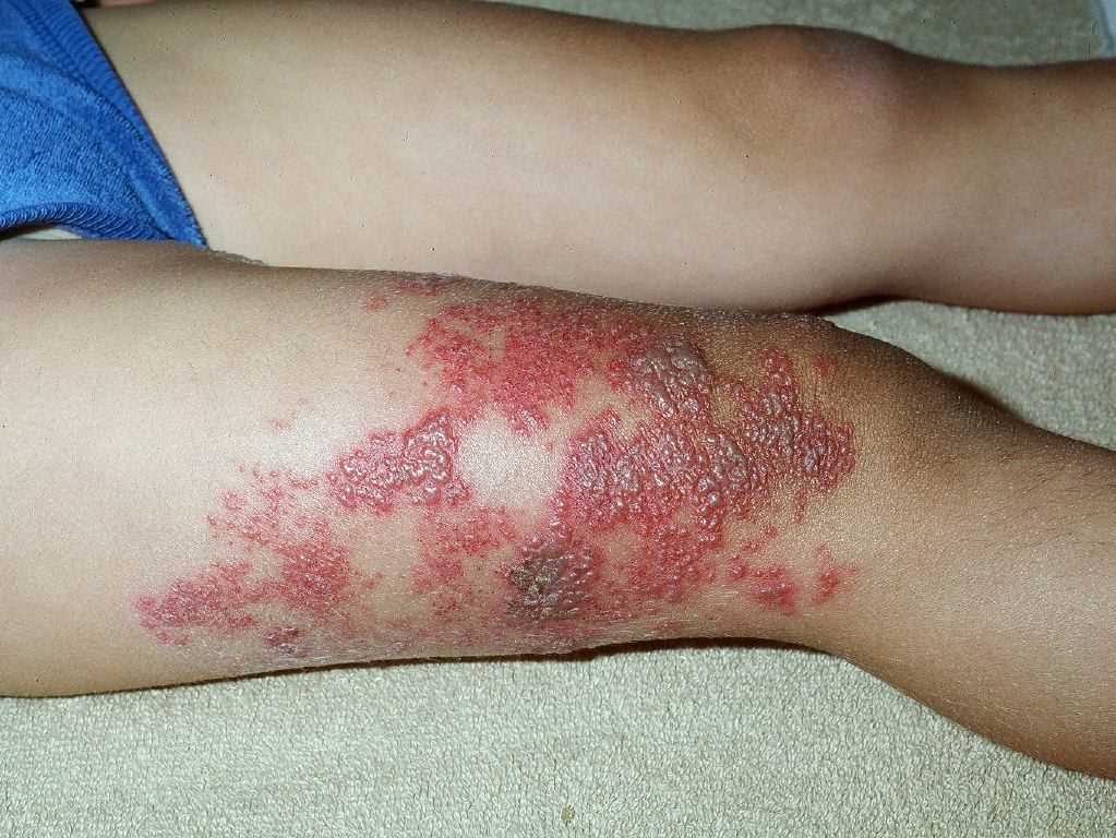<p>Herpes Zoster. Herpes zoster presents as a unilateral, dermatomal vesicular eruption on an erythematous base.</p>