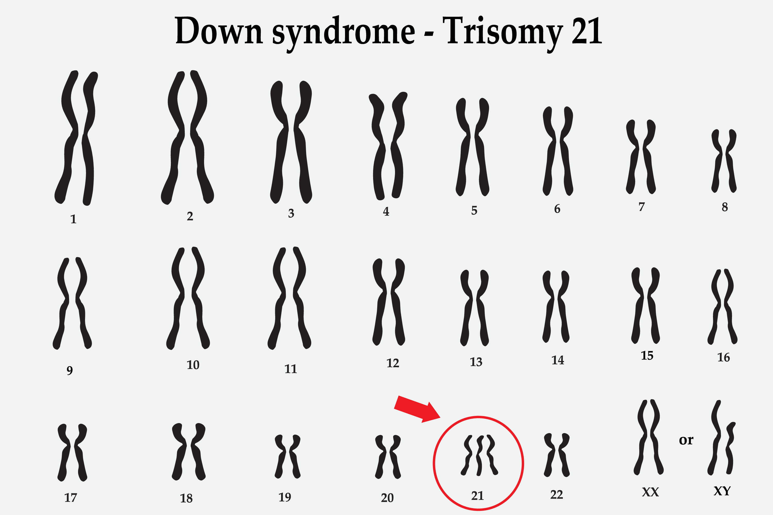 <p>Down Syndrome (Trisomy 21) Karyotype.</p>